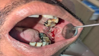 How a Routine Screening Led to Timely Oral Cancer Treatment